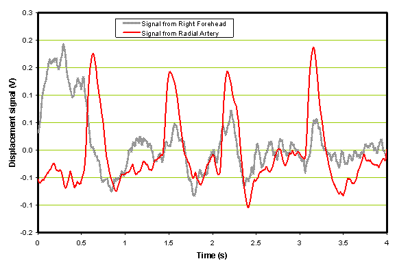 Example of sampled patient waveforms