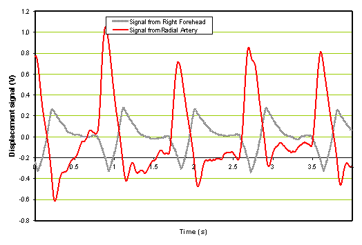 Time domain waveform from patient after rt-PA