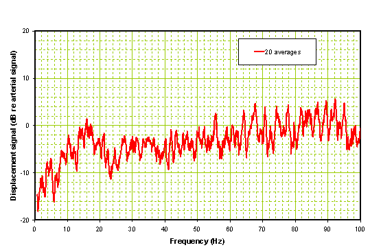 Frequency domain signal of patient after rt-PA