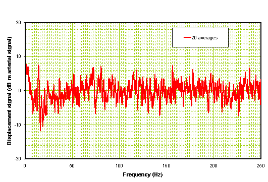 Processed frequency domain signal of hemorrhagic stroke patient
